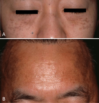 Pigmentary Disorders in Asian Skin: Treatment With Laser
