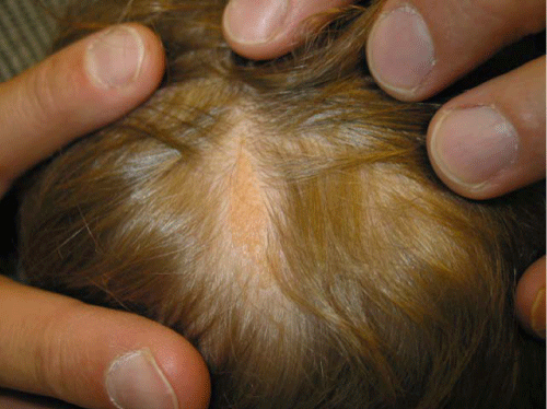 Trichilemmal cyst - Wikipedia