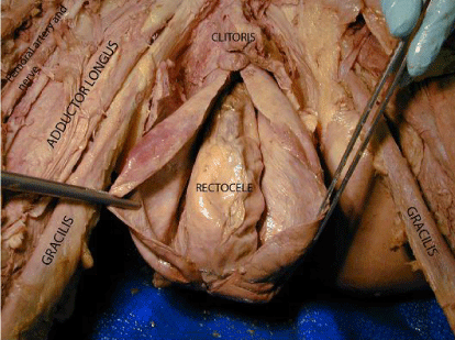 Enhanced Anatomy Provided by Clinical Anomaly: Fourth Stage Vaginal