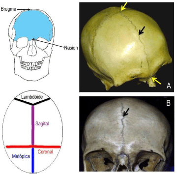 adult bregma suture metopic skulls indicate incidence brazil southeast anatomy schematic arrows representing ones points yellow figure drawing