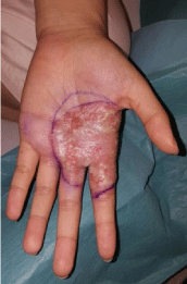 Inflammatory Tinea Manuum due to Trichophyton Erinacei from a
