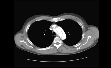 A Rare Presentation of a Life Threatening Condition Secondary to