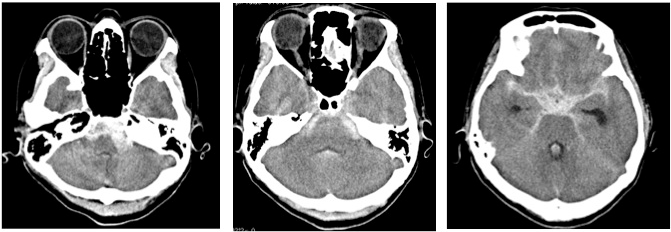 Hemorrhagic Dissection of the P1 Segment of Posterior Cerebral Artery ...