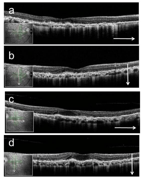 A Case of Dry Age-Related Macular Degeneration with Reticular Pseudodrusen