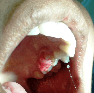 Gingival hyperplasia