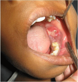 ameloblastic fibroma