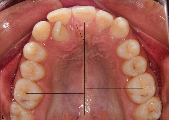 Figure 2B: Intraoral occlusal photograph showing the incisive papilla devia...