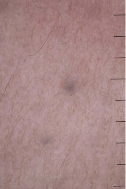 Dermoscopic Findings in Eruptive Vellus Hair Cysts: A Case Report