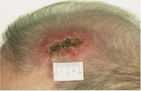 occiput scalp contusion