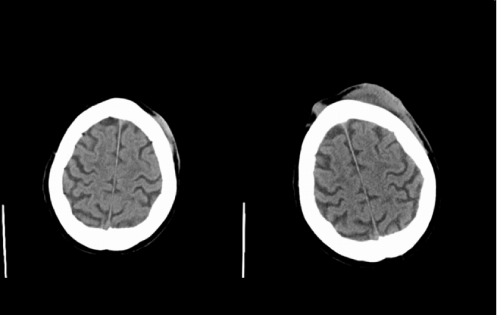 occiput scalp contusion