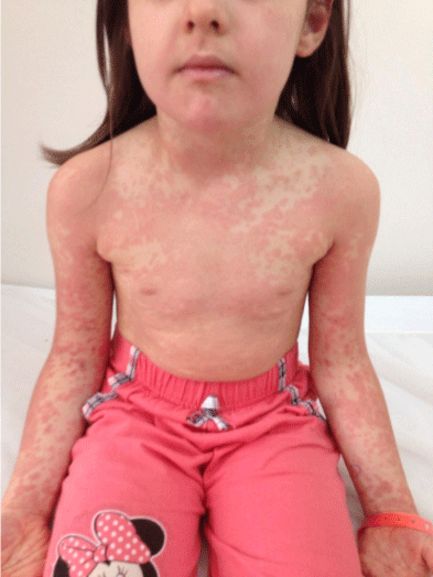 Mononucleosis Rash Treatment Goimages Virtual