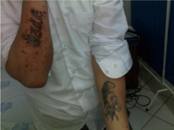 Tattoo Associated Allergic Contact Dermatitis