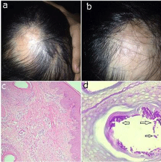 scarring alopecia histology