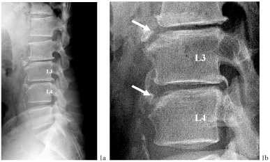 narrowing of the space in between vertebrae