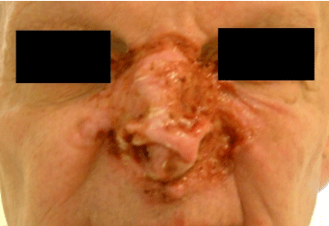 A Case Of Unresectable Basal Cell Carcinoma With Response To Novel