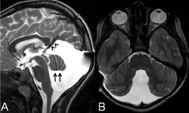 The Role of Neuroimaging in Congenital Abnormalities of the Posterior Fossa