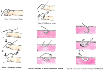 Cureus  CUT BARB (an Acronym for Fishhook Injuries): Illustrated