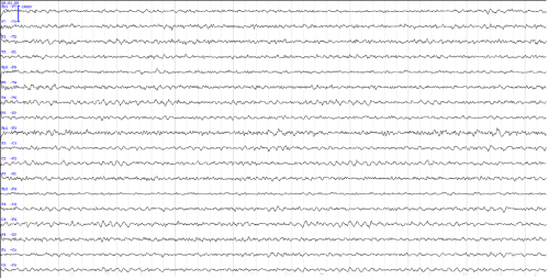 abnormal eeg results